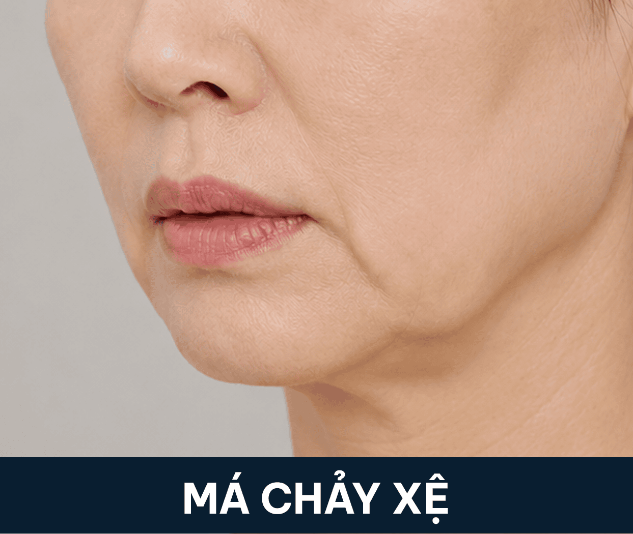 má chảy xệ