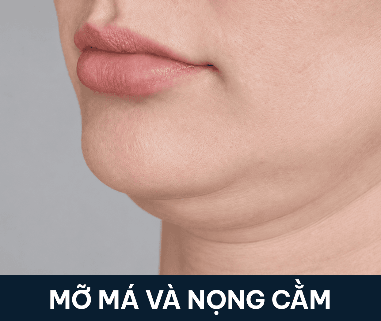 mỡ má nọng cằm