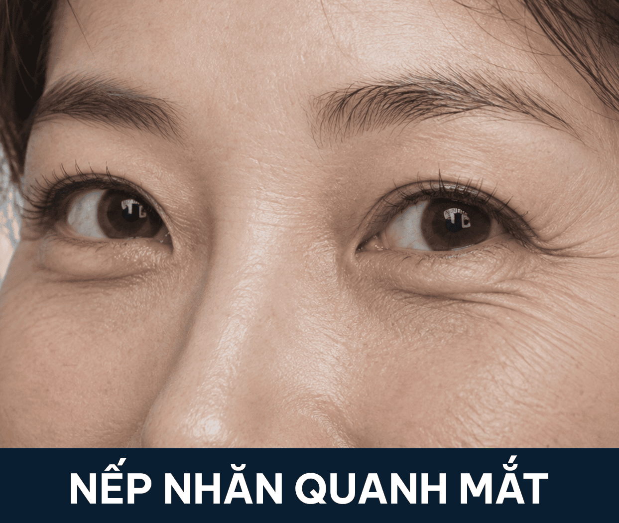 nếp nhăn quanh mắt