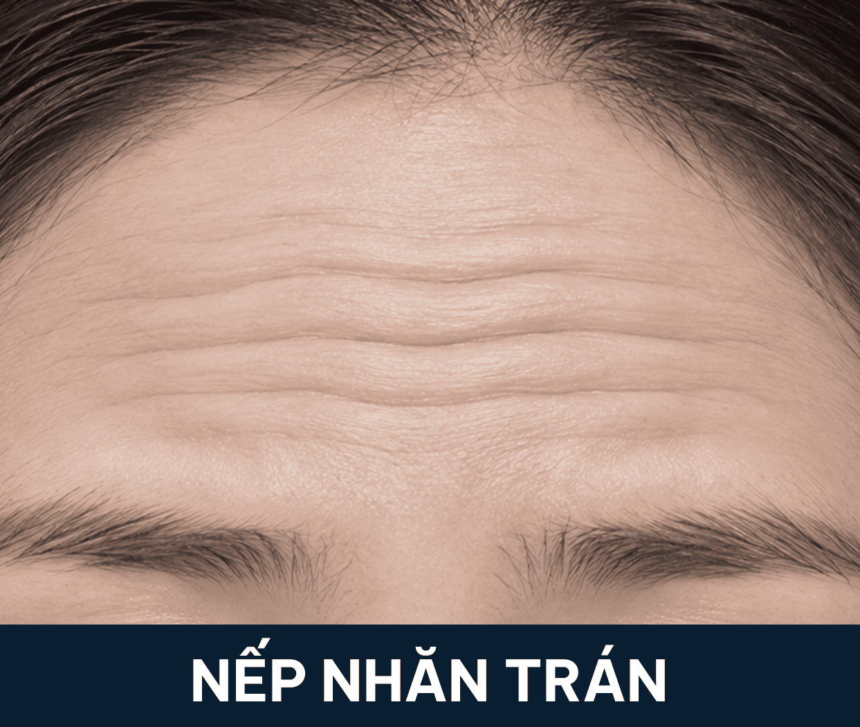 nhăn trán